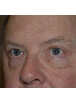 After Image: Upper Eyelid - left-front-oblique