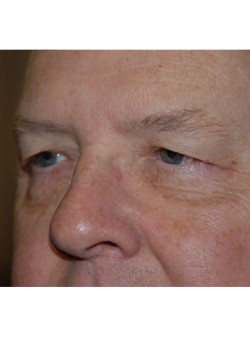 Before Image: Upper Eyelid - left-front-oblique