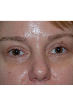 After Image: Upper Eyelid - front