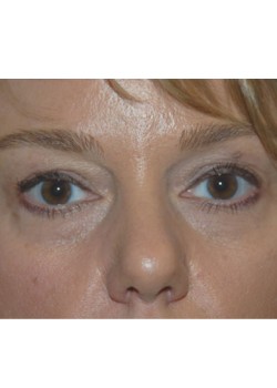 Before Image: Upper Eyelid - front