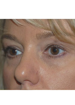 Before Image: Upper Eyelid - left-front-oblique