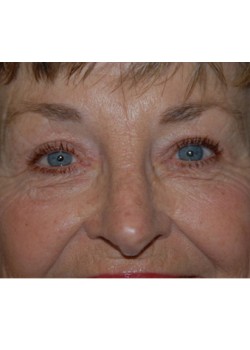 After Image: Upper Eyelid - front