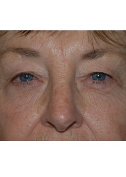 Before Image: Upper Eyelid - front