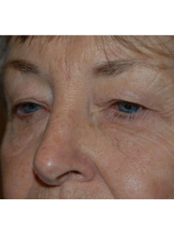 Before Image: Upper Eyelid - left-front-oblique