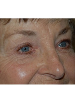 After Image: Upper Eyelid - right-front-oblique