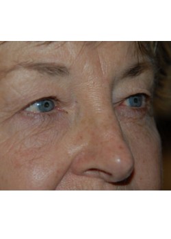 Before Image: Upper Eyelid - right-front-oblique
