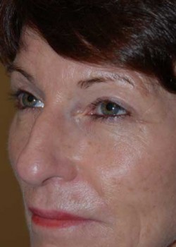 After Image: Upper Eyelid - left-front-oblique