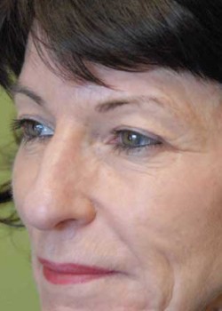 Before Image: Upper Eyelid - left-front-oblique
