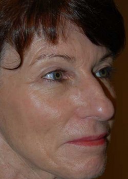 After Image: Upper Eyelid - right-front-oblique
