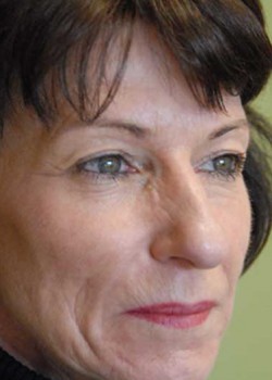 Before Image: Upper Eyelid - right-front-oblique