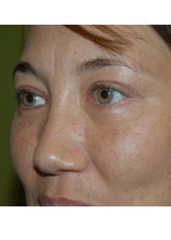 After Image: Upper and Lower Eyelid - left-front-oblique
