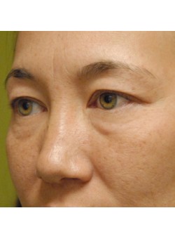 Before Image: Upper and Lower Eyelid - left-front-oblique