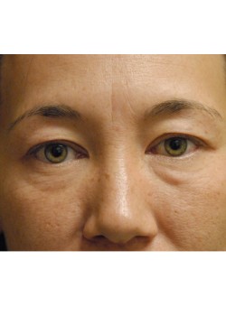 Before Image: Upper and Lower Eyelid - front