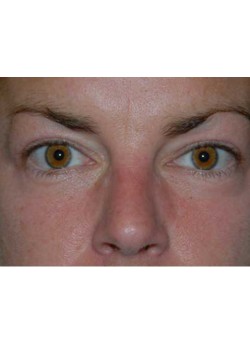 After Image: Upper Eyelid - front