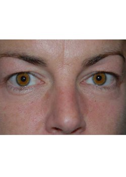 Before Image: Upper Eyelid - front