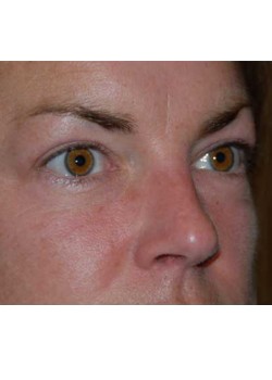 After Image: Upper Eyelid - right-front-oblique