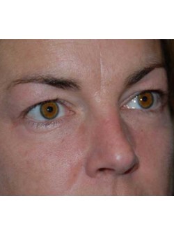Before Image: Upper Eyelid - right-front-oblique