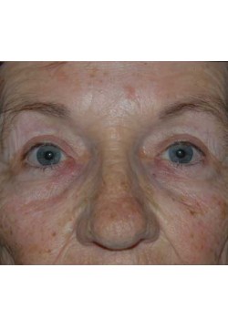 After Image: Upper Eyelid - front
