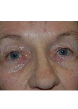 Before Image: Upper Eyelid - front