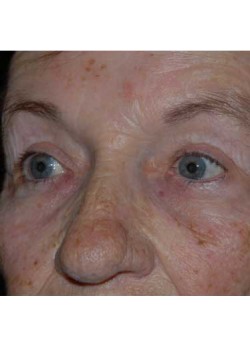 After Image: Upper Eyelid - left-front-oblique
