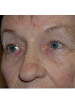 Before Image: Upper Eyelid - left-front-oblique