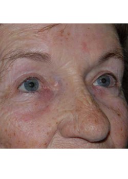 After Image: Upper Eyelid - right-front-oblique