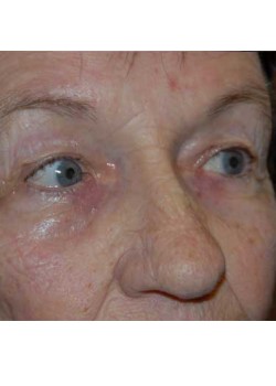 Before Image: Upper Eyelid - right-front-oblique