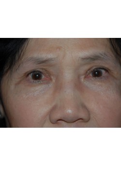 After Image: Upper Eyelid - front