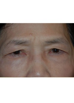 Before Image: Upper Eyelid - front