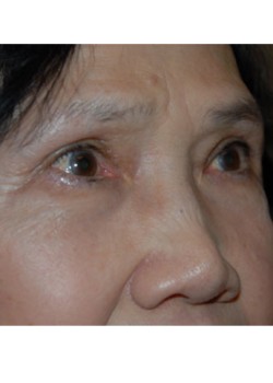 After Image: Upper Eyelid - right-front-oblique