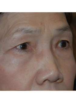 Before Image: Upper Eyelid - right-front-oblique
