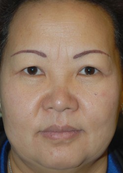 After Image: Upper and Lower Eyelid - front