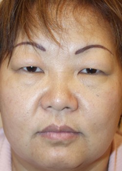 Before Image: Upper and Lower Eyelid - front