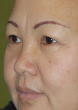 After Image: Upper and Lower Eyelid - left-front-oblique