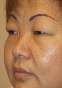 Before Image: Upper and Lower Eyelid - left-front-oblique