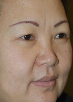 After Image: Upper and Lower Eyelid - right-front-oblique