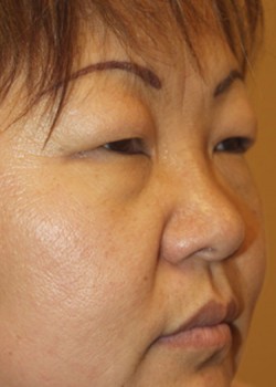 Before Image: Upper and Lower Eyelid - right-front-oblique