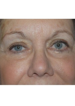 After Image: Lower Eyelid - front