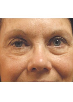 Before Image: Lower Eyelid - front