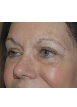 After Image: Lower Eyelid - left-front-oblique