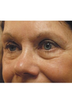 Before Image: Lower Eyelid - left-front-oblique