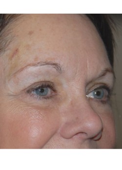 After Image: Lower Eyelid - right-front-oblique