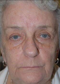 After Image: Upper and Lower Eyelid - front