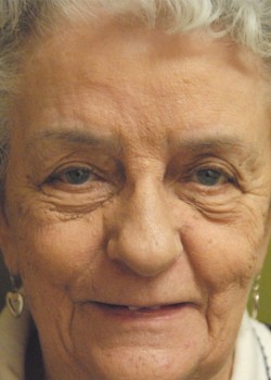 Before Image: Upper and Lower Eyelid - front