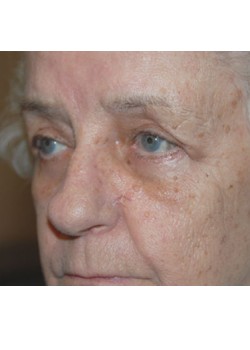 After Image: Upper and Lower Eyelid - left-front-oblique