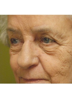 Before Image: Upper and Lower Eyelid - left-front-oblique