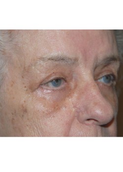 After Image: Upper and Lower Eyelid - right-front-oblique