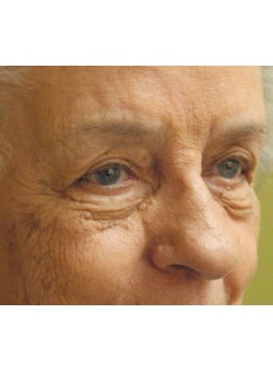 Before Image: Upper and Lower Eyelid - right-front-oblique