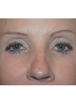 After Image: Lower Eyelid - front