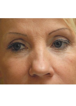 Before Image: Lower Eyelid - front